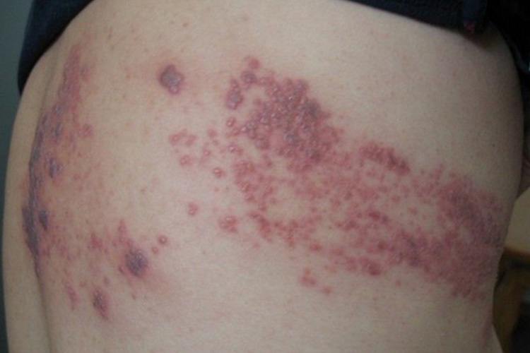 铜红色斑疹图