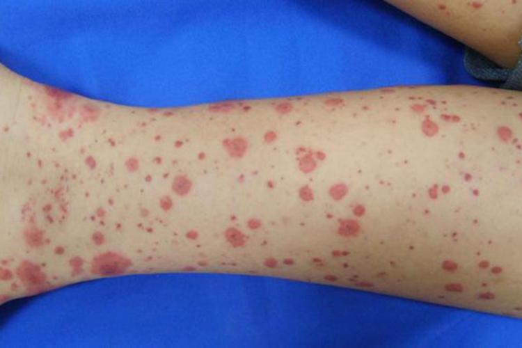 青斑样血管炎初期症状图