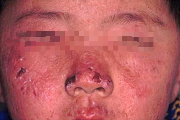 原卟啉病面部症状图 原卟啉病面部症状图