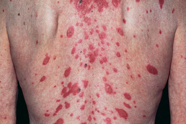 亚急性皮肤型红斑狼疮图