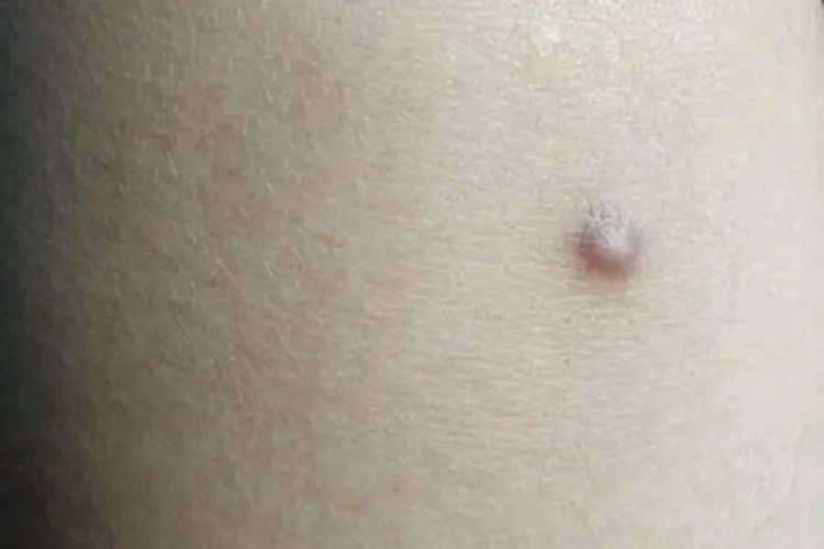 毛囊周围纤维瘤胳膊结节图