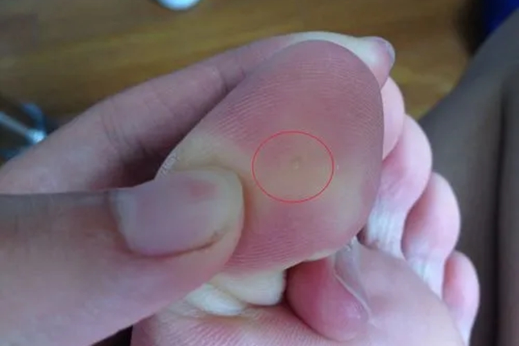 脚上长鸡眼最初图