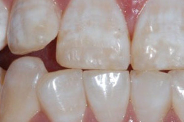 氟牙症白垩型图 氟牙症白垩型图