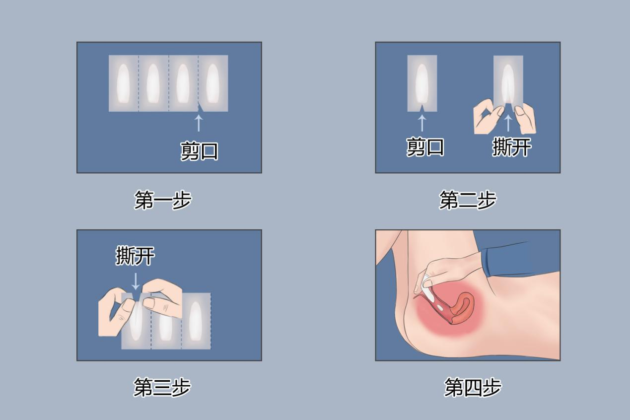 克霉唑阴道膨胀栓使用流程图
