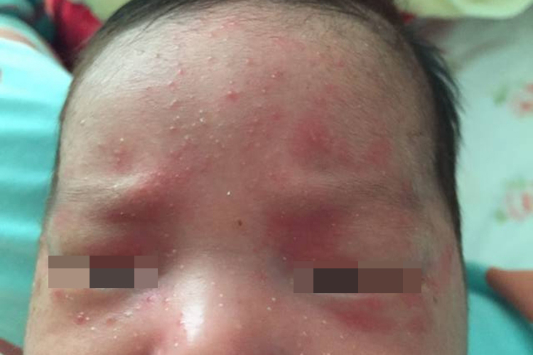 脸部红痱丘疹图