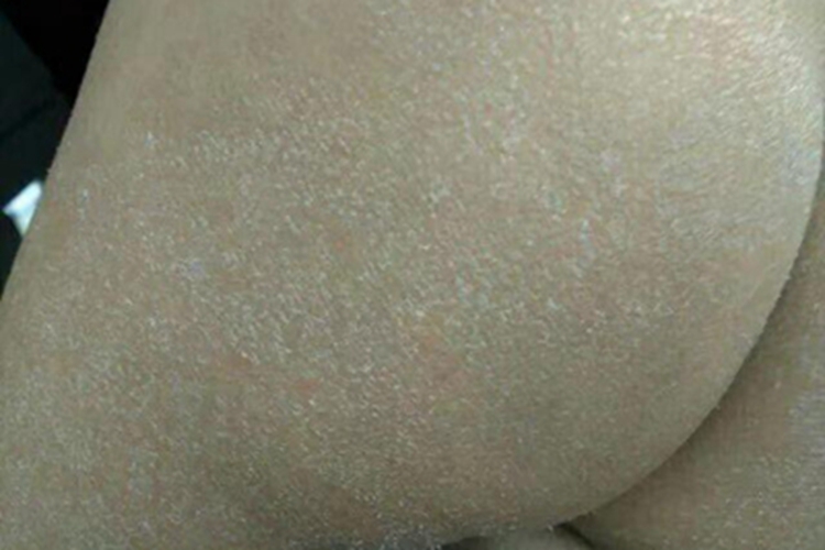 青年成人期特应性皮炎臀部脱屑图