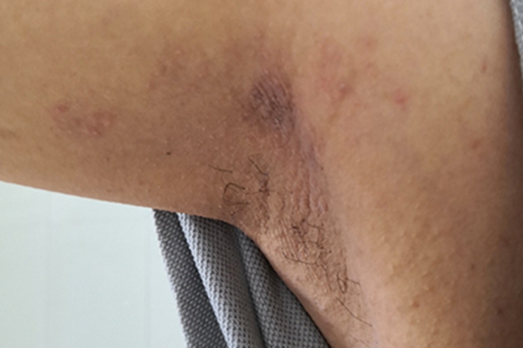 玫瑰糠疹右腋窝长红斑图 玫瑰糠疹右腋窝长红斑图