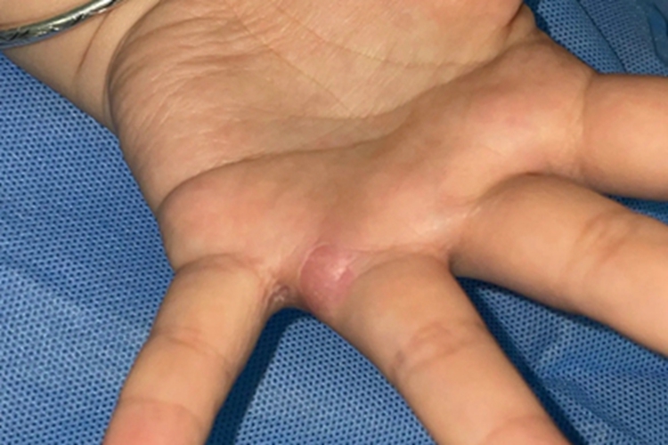 毛发肉芽肿手指缝小红疙瘩图 毛发肉芽肿手指缝小红疙瘩图