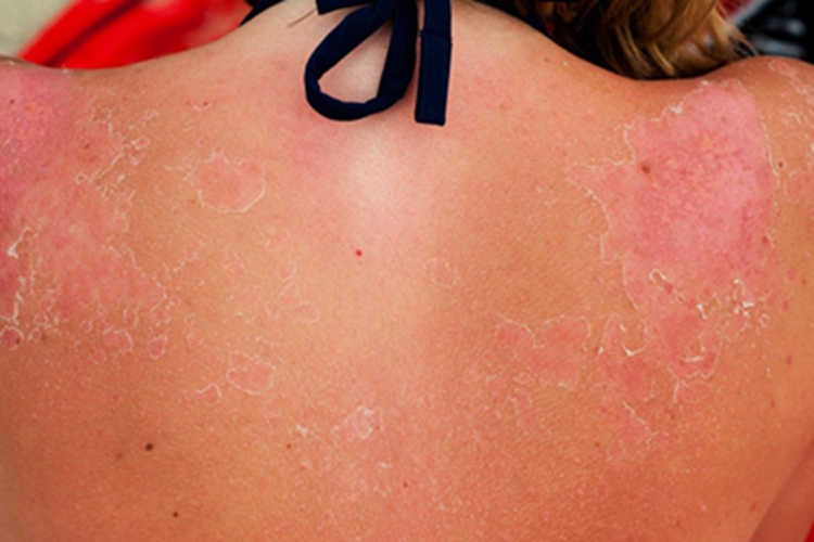 日光性皮炎背部脱皮图