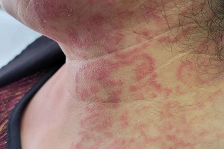 多形红斑颈部红斑图