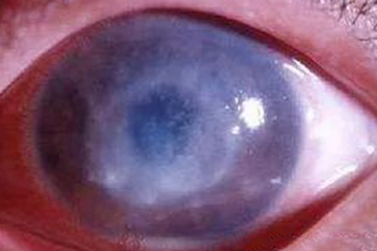 暴露性角膜炎眼球混浊图 暴露性角膜炎眼球混浊图