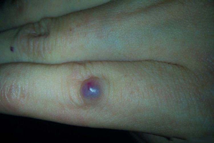 化脓性肉芽肿手指结节图