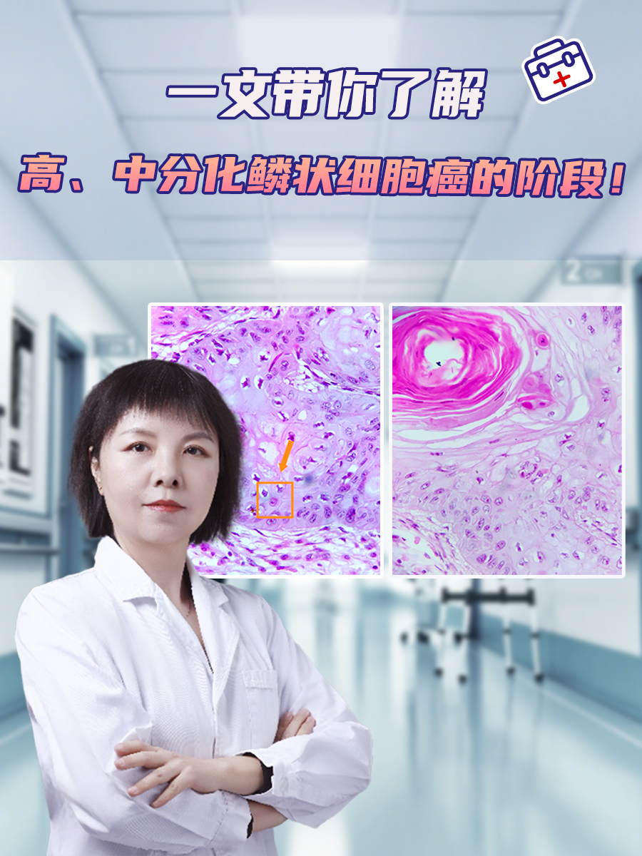 一文带你了解高、中分化鳞状细胞癌的阶段！