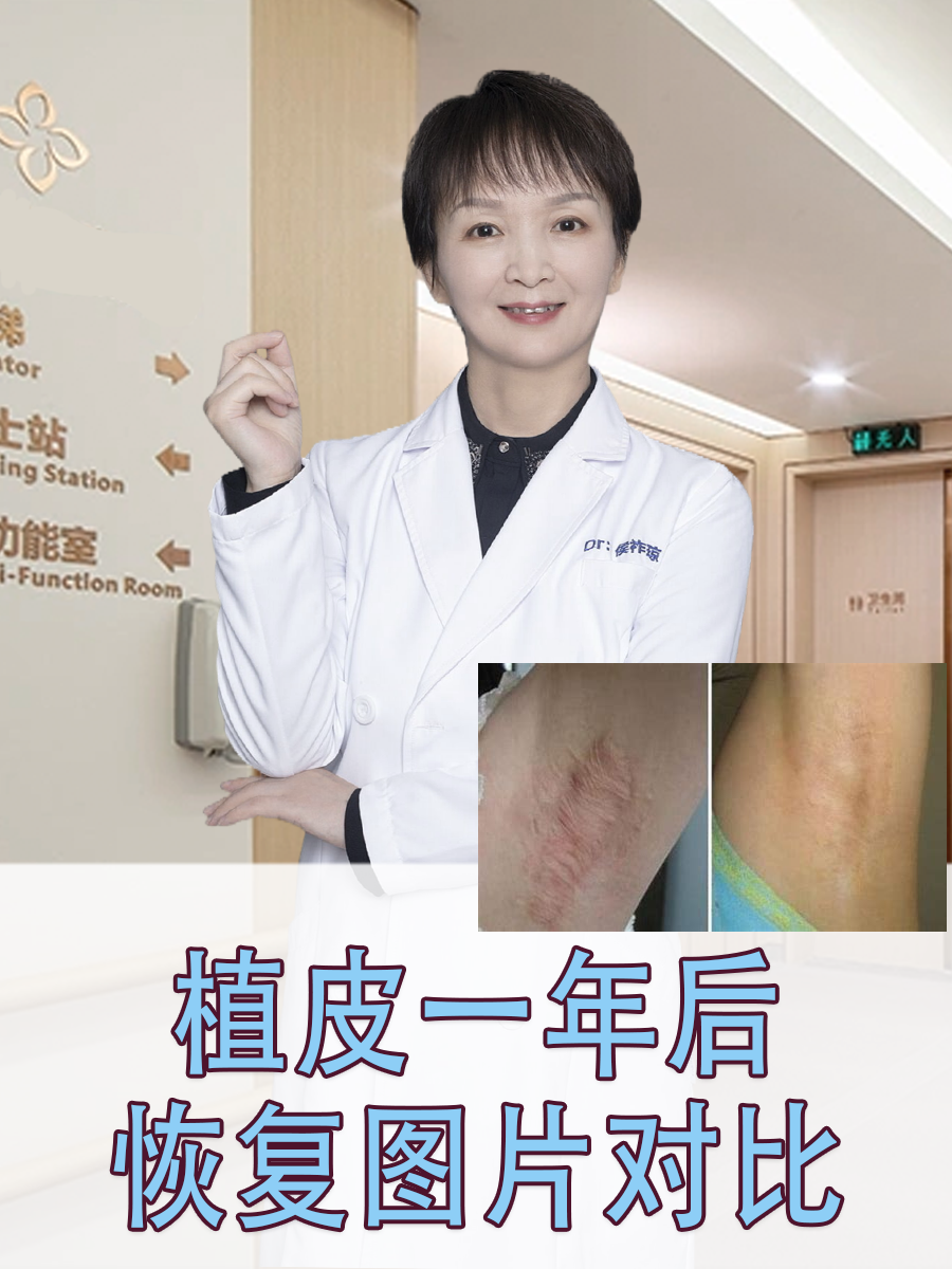 植皮一年后恢复图片对比