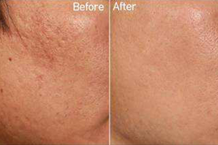 点阵激光前后对比效果图