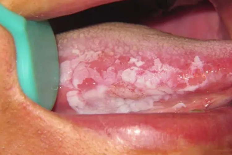 口腔白色角化病图