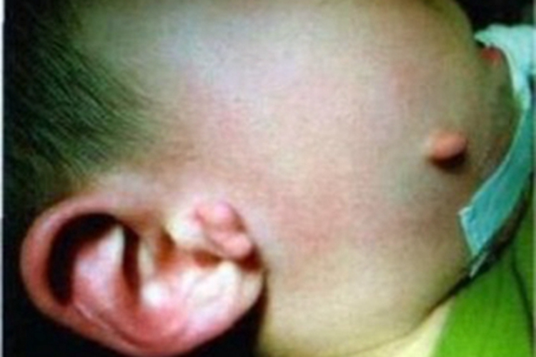 副耳症状图 副耳症状图