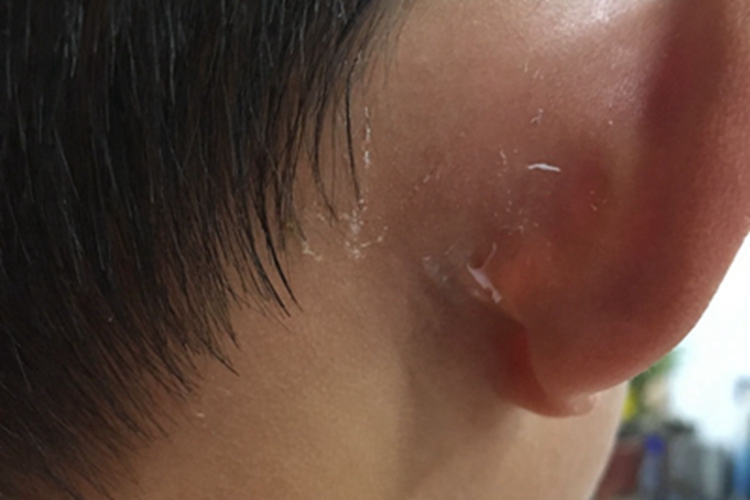 耳后骨膜下脓肿耳后脱屑图 耳后骨膜下脓肿耳后脱屑图