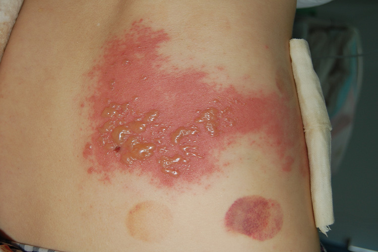 带状疱疹水疱症状图