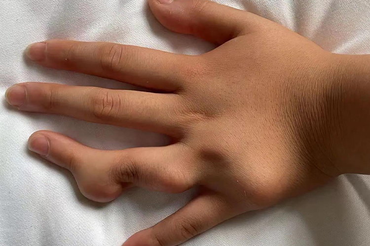 手指关节软骨瘤图