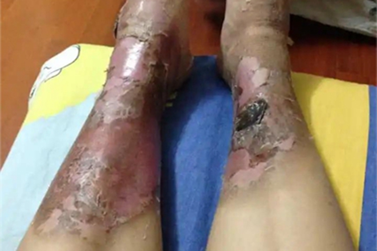 二度烫伤皮肤发黑图 二度烫伤皮肤发黑图