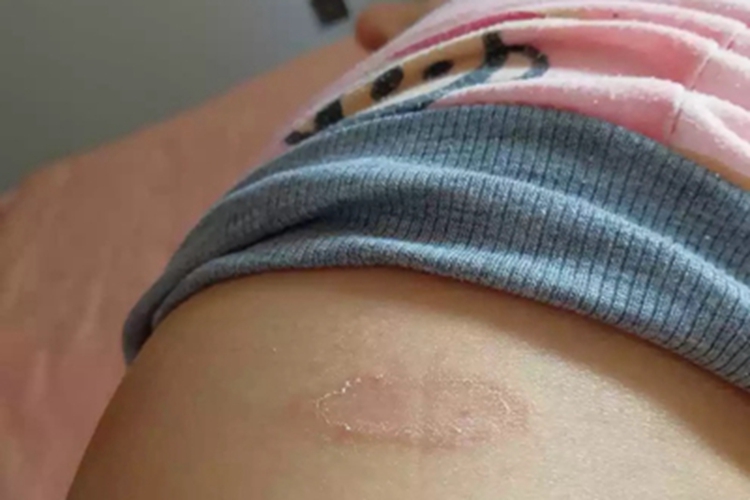 离心性环状红斑腹部红斑图