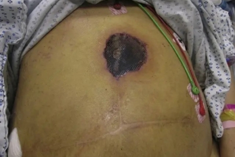 皮肤型毛霉病症状图