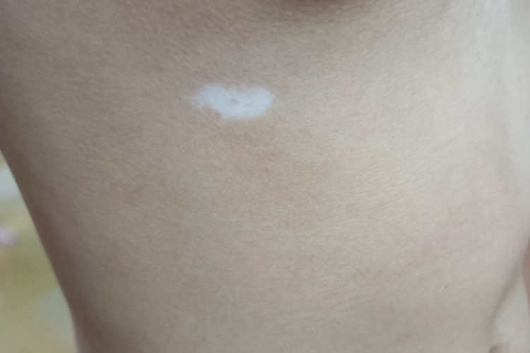 白癜风躯干皮肤颜色变浅图