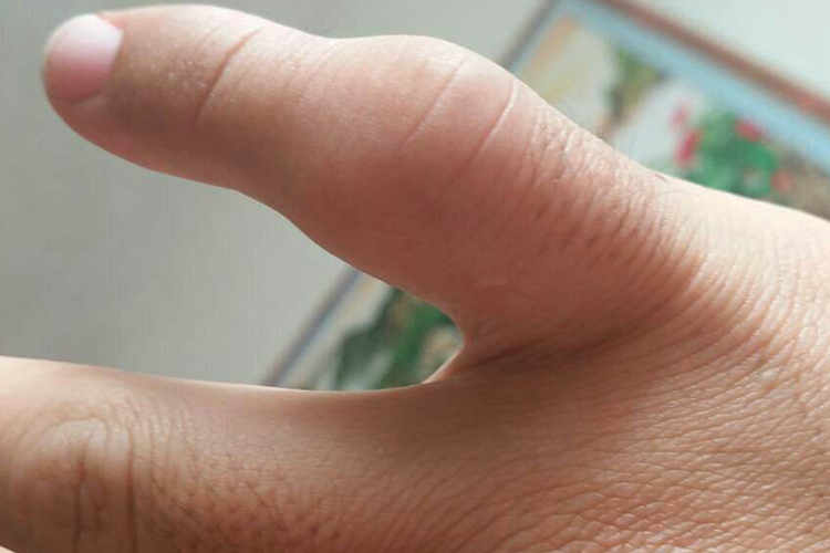狭窄性腱鞘炎第二关节畸形图