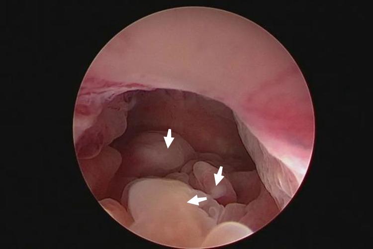 宫腔镜下宫腔息肉图