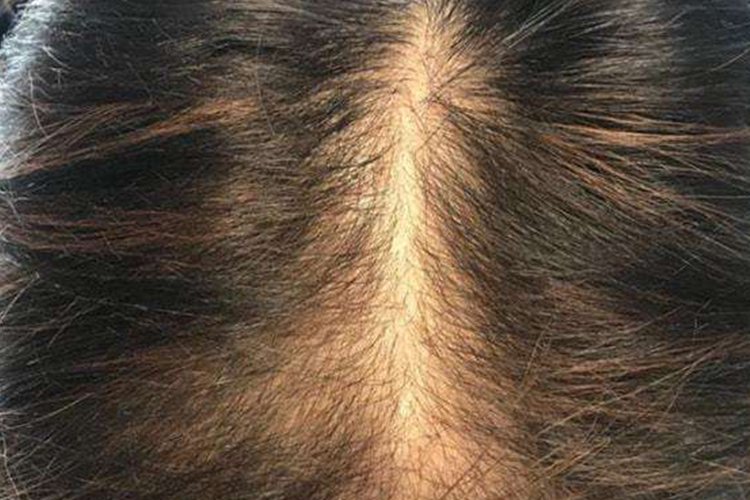 女性脂溢性脱发Ⅱ级图 女性脂溢性脱发Ⅱ级图