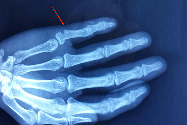 指骨骨折图