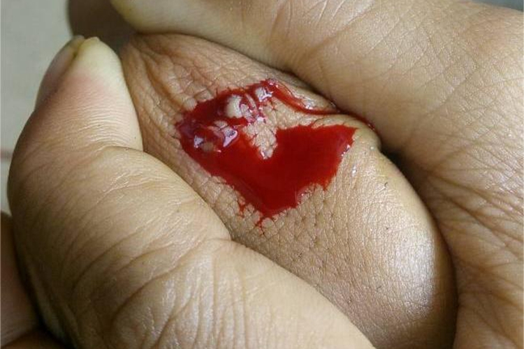 戳伤手部出血图 戳伤手部出血图