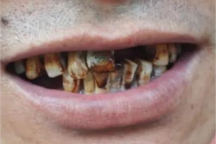 氟骨症牙齿症状图