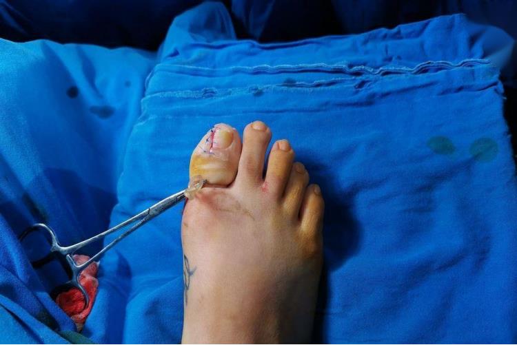 甲沟炎手术切口缝合图