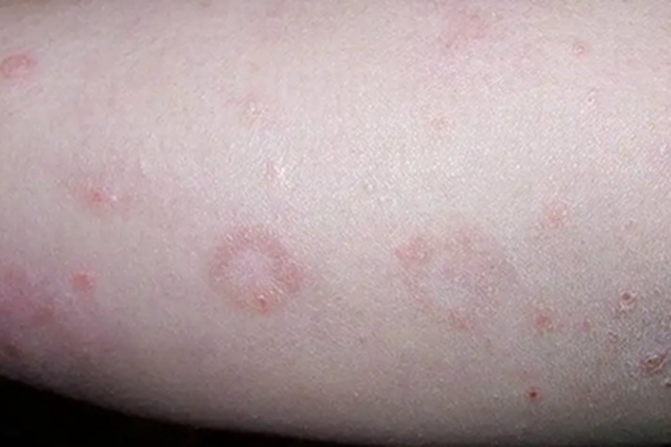 银屑病手臂圆形白斑图