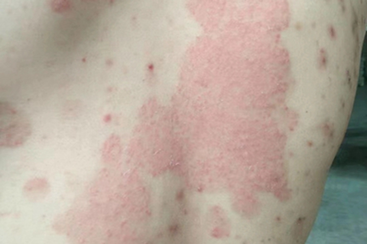 体癣背部症状图 体癣背部症状图