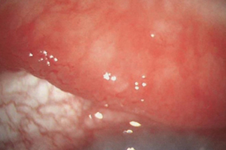 混合型春季角结膜炎长小疙瘩图