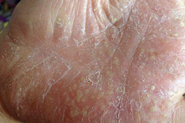 角层下脓疱性皮病手掌脱皮图