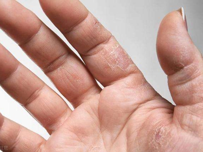急性维生素A过多症手指干裂脱皮图.jpg