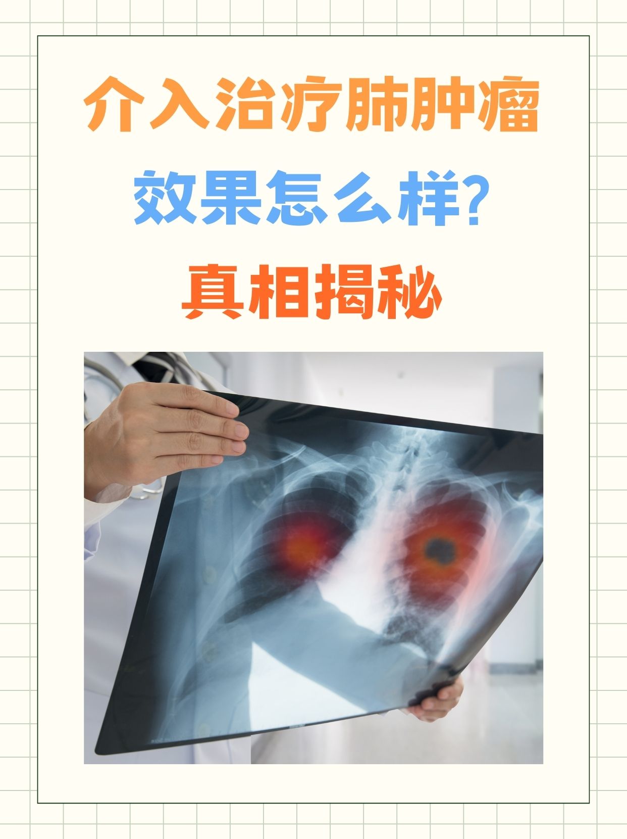 介入治疗肺肿瘤效果怎么样?真相揭秘