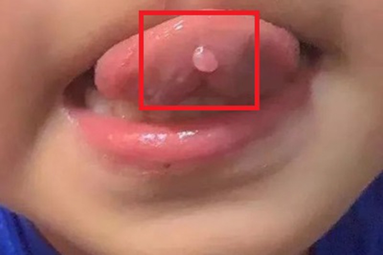 黏液腺囊肿软包图