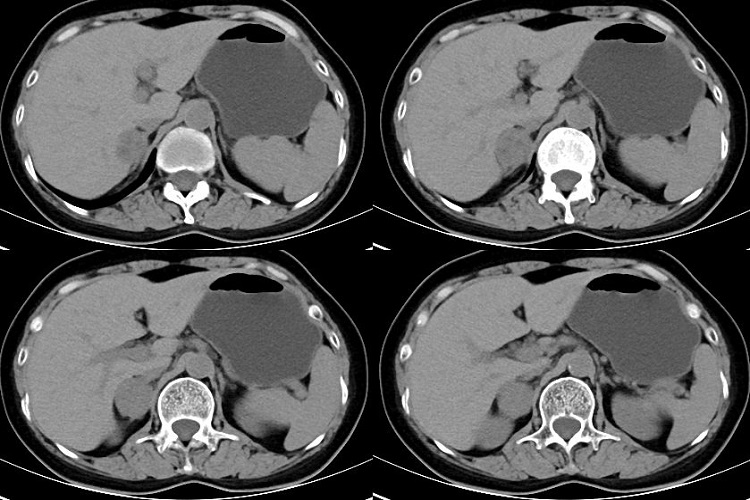 肾上腺肿块CT表现图