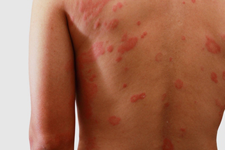 体癣后背有很多鲜红色斑块图