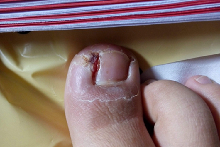 慢性甲沟炎糜烂图