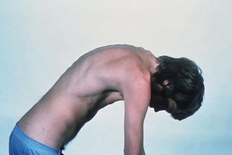 强直性脊柱炎驼背图