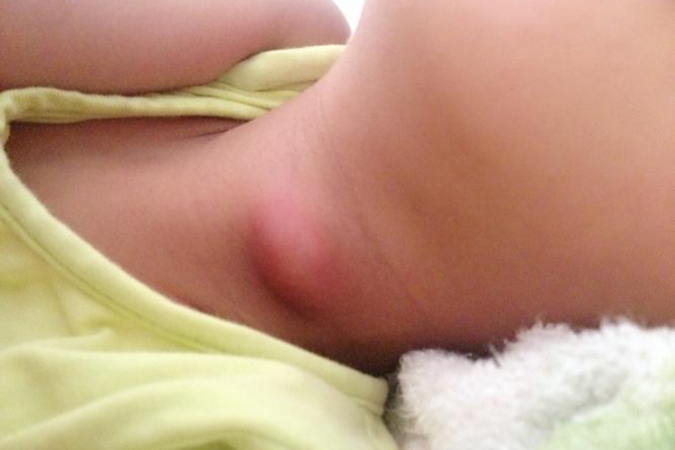 梨状窝瘘图