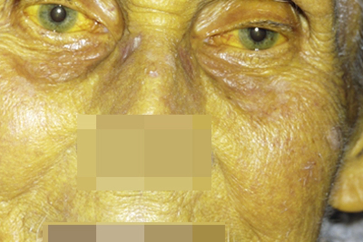 先天性非溶血性黄疸症状图