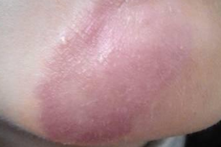 下巴体癣红色斑片图 下巴体癣红色斑片图