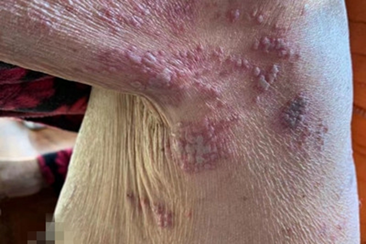 带状疱疹腋窝症状图 带状疱疹腋窝症状图
